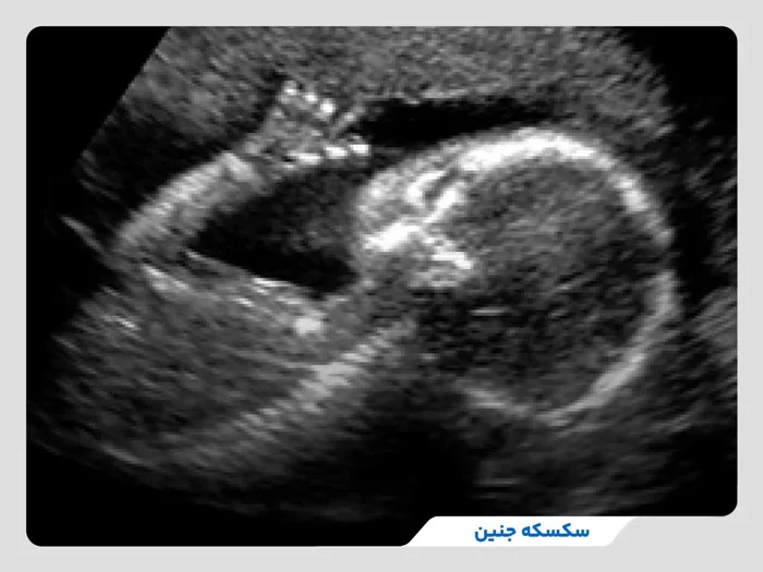 همه چیز درباره سکسکه جنین: از علل تا راهکارهای رفع آن